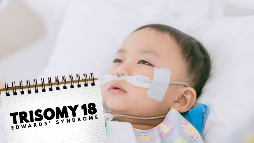 Apa Itu Edwards Syndrome : Gejala, Penyebab, dan Diagnosis