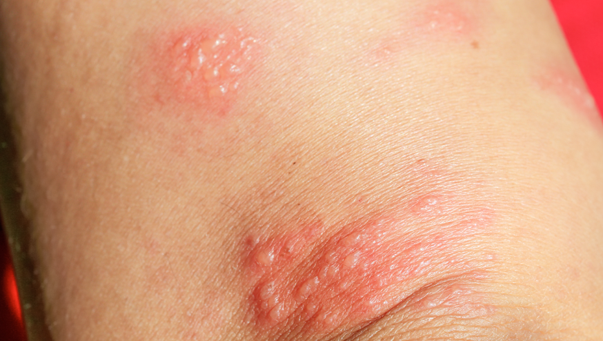 Pemphigoid: Penyebab, Gejala, Diagnosis, dan Pengobatan