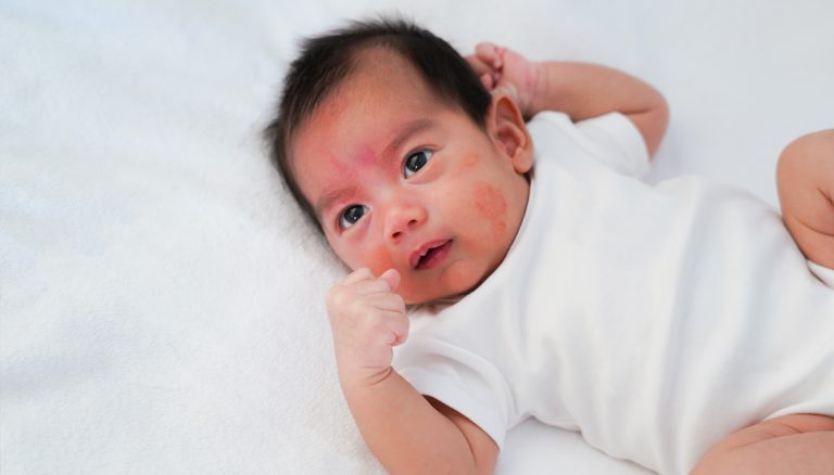 Alergi pada Balita & Pentingnya Tes IgE Panel Pediatri